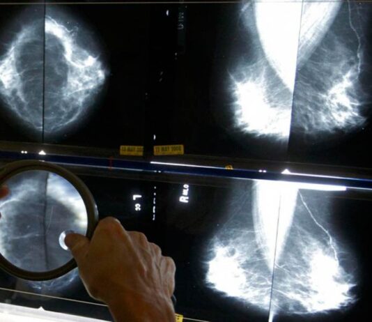 Tumore al seno, via libera al test genomico gratuito